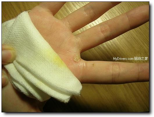 戴尔行货笔记本漏电烧伤国内用户全纪录(组图